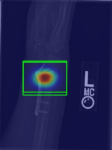 Ankle X-ray with Grad-CAM