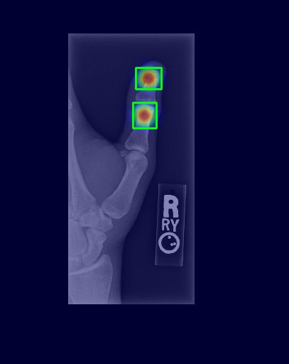 Wrist X-ray with Grad-CAM
